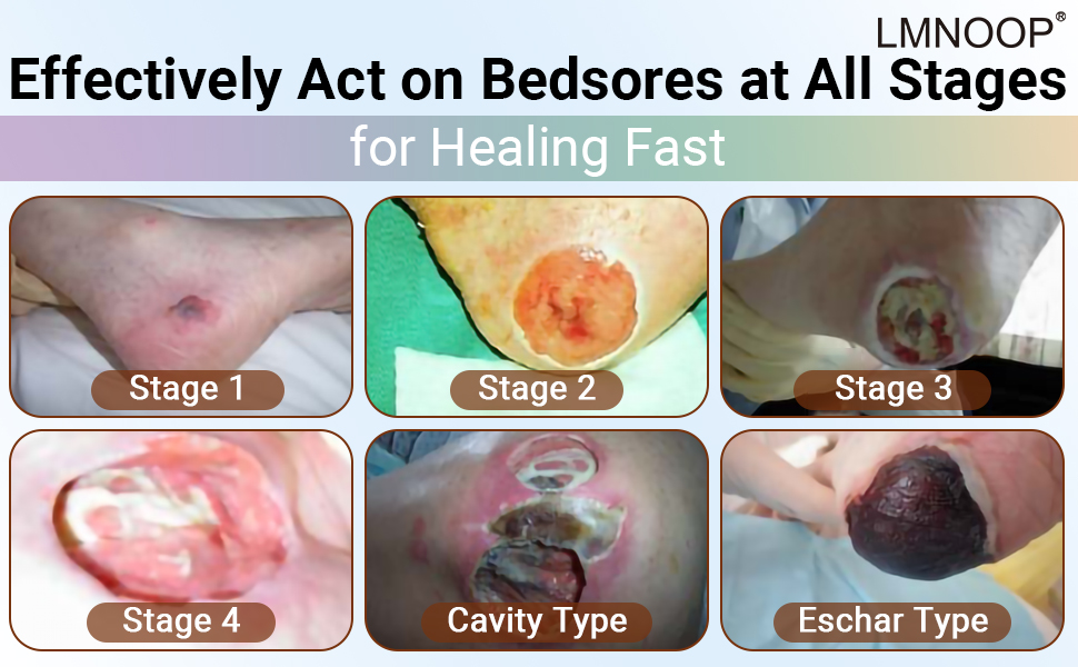Pressure Sores Cream, Wound Healing Ointment Skin Repair Treatment Infection Protection First Aid Ointment for Pressure Sores