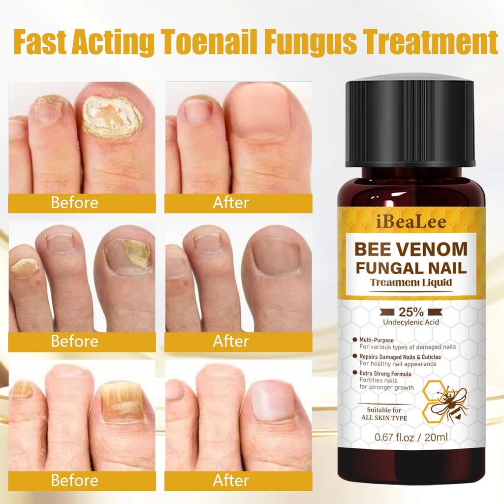toenail-fungus-treatment-extra-strength--4.jpg