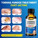 toenail-fungus-treatment-extra-strength--3.jpg