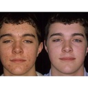 acnetame-acne-pills-vitamin-supplements--4.jpg